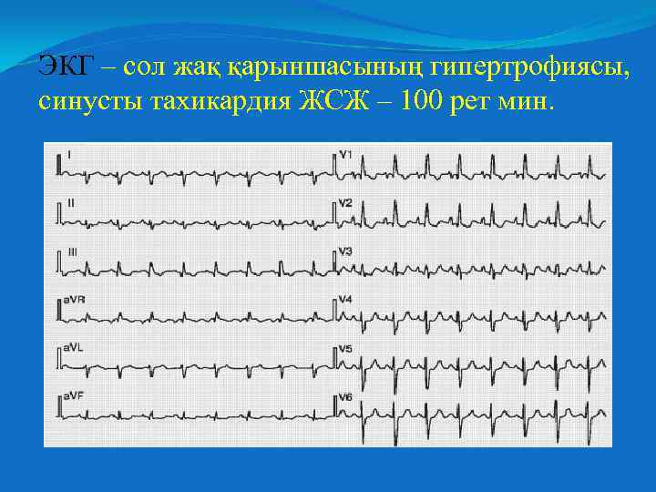 ЭКГ – сол жақ қарыншасының гипертрофиясы, синусты тахикардия ЖСЖ – 100 рет мин. 