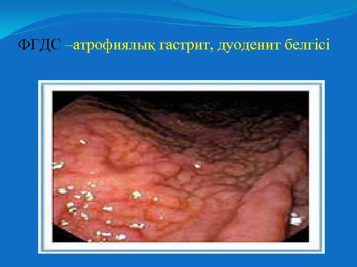 ФГДС –атрофиялық гастрит, дуоденит белгісі 