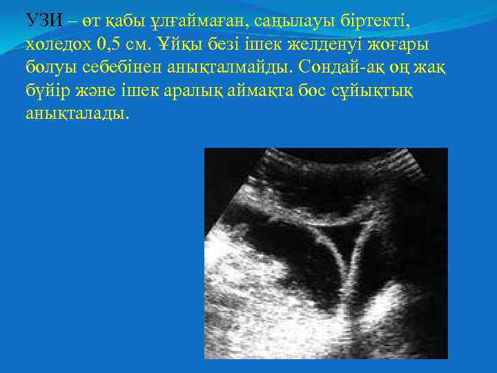 УЗИ – өт қабы ұлғаймаған, саңылауы біртекті, холедох 0, 5 см. Ұйқы безі ішек