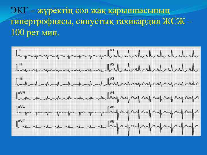 ЭКГ – жүректің сол жақ қарыншасының гипертрофиясы, синустық тахикардия ЖСЖ – 100 рет мин.