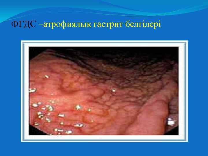 ФГДС –атрофиялық гастрит белгілері 