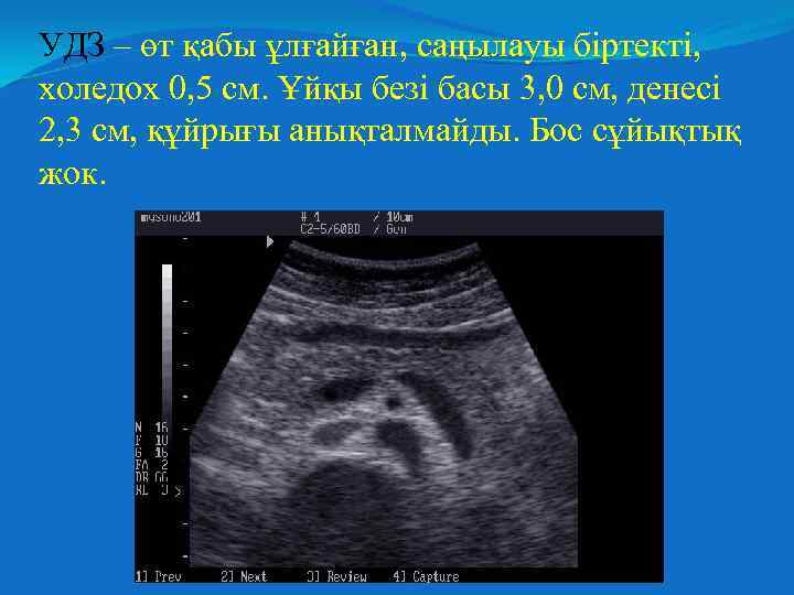 УДЗ – өт қабы ұлғайған, саңылауы біртекті, холедох 0, 5 см. Ұйқы безі басы