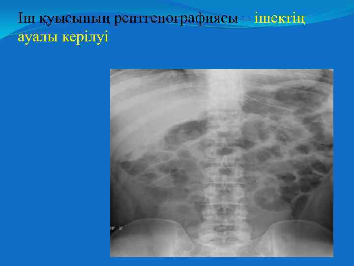 Іш қуысының рентгенографиясы – ішектің ауалы керілуі 