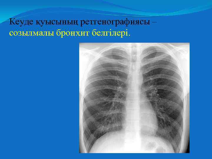 Кеуде қуысының ретгенографиясы – созылмалы бронхит белгілері. 