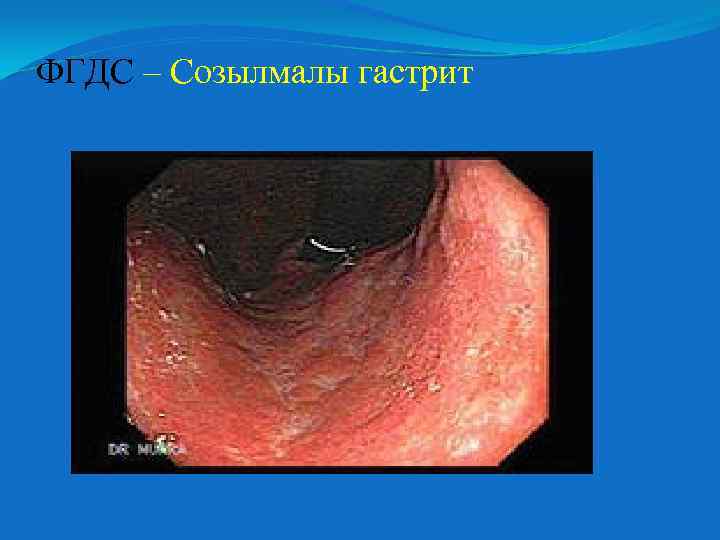 ФГДС – Созылмалы гастрит 