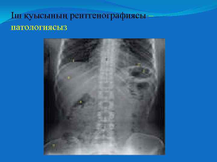 Іш қуысының рентгенографиясы – патологиясыз 