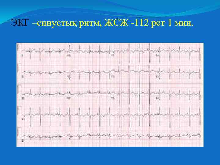 ЭКГ –синустық ритм, ЖСЖ -112 рет 1 мин. 