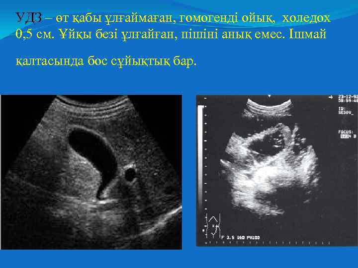 УДЗ – өт қабы ұлғаймаған, гомогенді ойық, холедох 0, 5 см. Ұйқы безі ұлғайған,