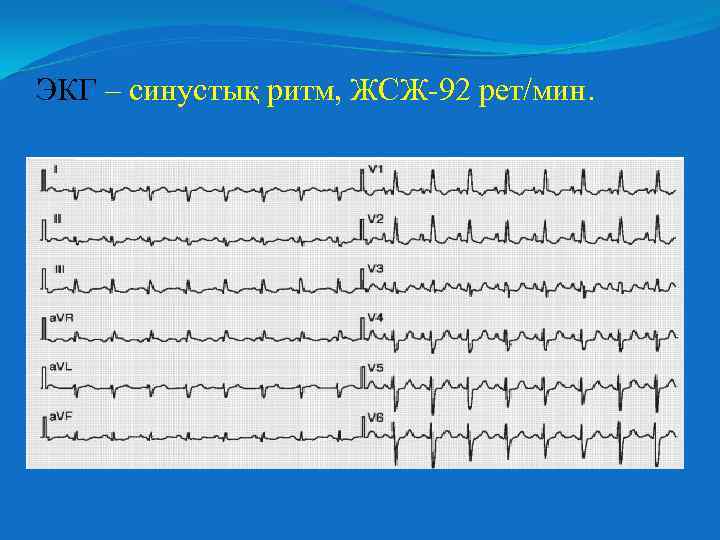ЭКГ – синустық ритм, ЖСЖ-92 рет/мин. 