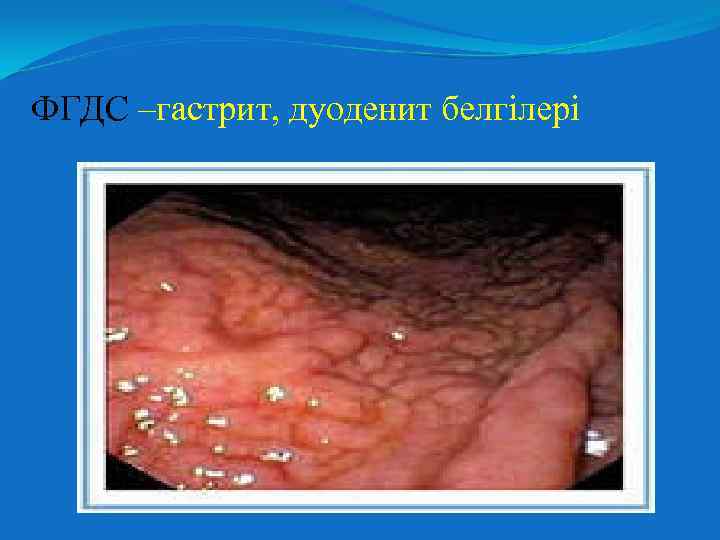 ФГДС –гастрит, дуоденит белгілері 