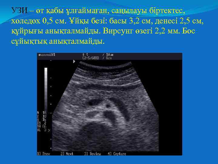 УЗИ – өт қабы ұлғаймаған, саңылауы біртектес, холедох 0, 5 см. Ұйқы безі: басы