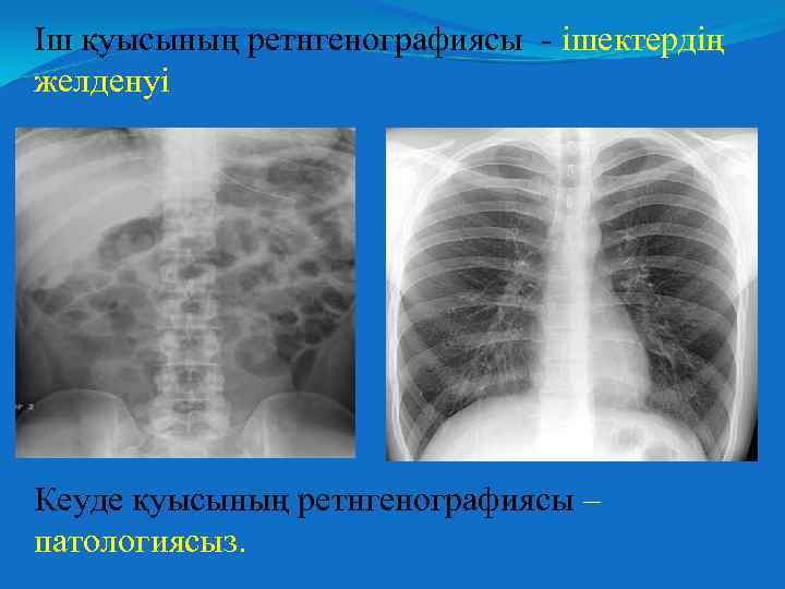 Іш қуысының ретнгенографиясы - ішектердің желденуі Кеуде қуысының ретнгенографиясы – патологиясыз. 