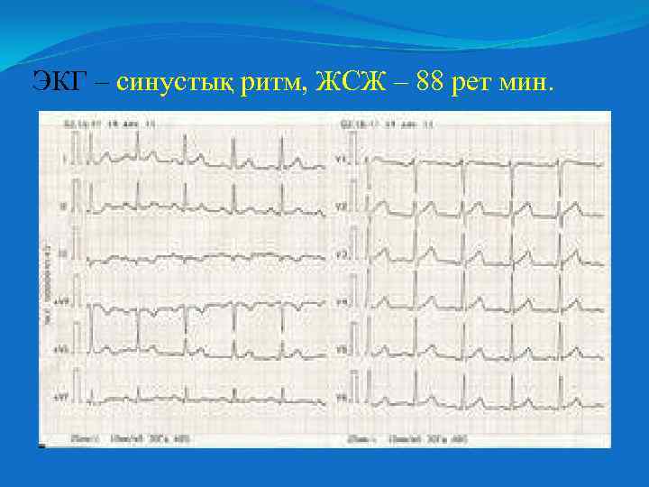 ЭКГ – синустық ритм, ЖСЖ – 88 рет мин. 