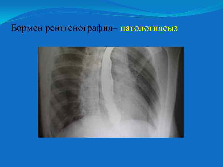 Бормен рентгенография– патологиясыз 