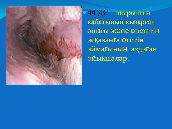  ФГДС – шырышты қабатының қызарған ошағы және өнештің асқазанға өтетін аймағының аздаған ойықшалар.