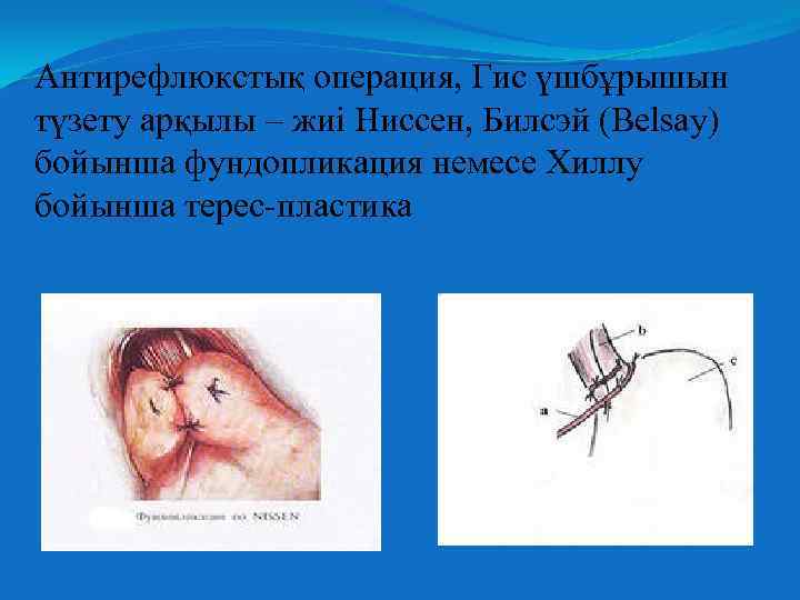 Антирефлюкстық операция, Гис үшбұрышын түзету арқылы – жиі Ниссен, Билсэй (Belsay) бойынша фундопликация немесе