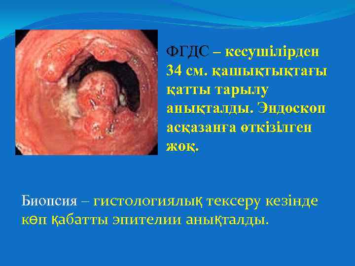 ФГДС – кесушілірден 34 см. қашықтықтағы қатты тарылу анықталды. Эндоскоп асқазанға өткізілген жоқ. Биопсия