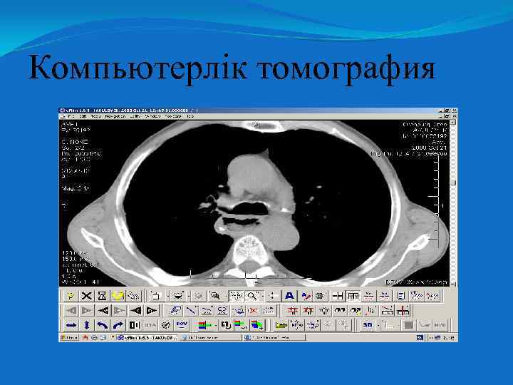 Компьютерлік томография 