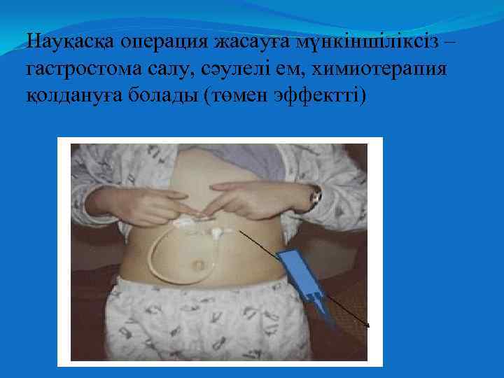 Науқасқа операция жасауға мүнкіншіліксіз – гастростома салу, сәулелі ем, химиотерапия қолдануға болады (төмен эффектті)