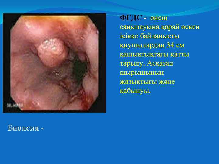 ФГДС - өнеш саңылауына қарай өскен ісікке байланысты қиушылардан 34 см қашықтықтағы қатты тарылу.