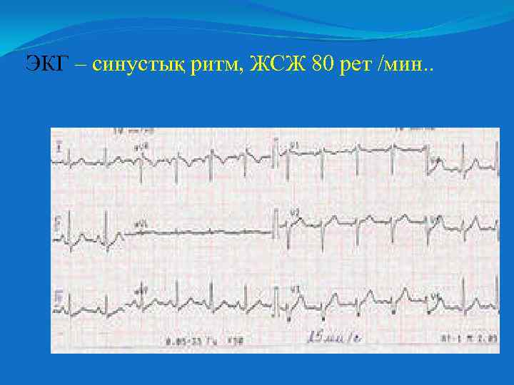 ЭКГ – синустық ритм, ЖСЖ 80 рет /мин. . 