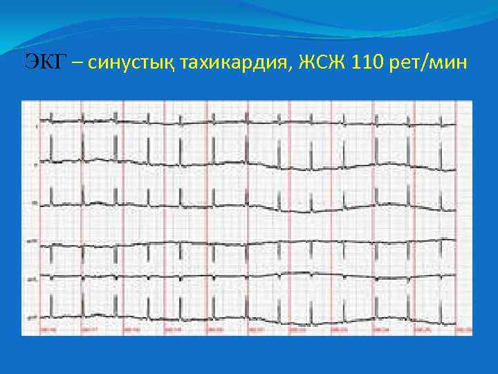 ЭКГ – синустық тахикардия, ЖСЖ 110 рет/мин 