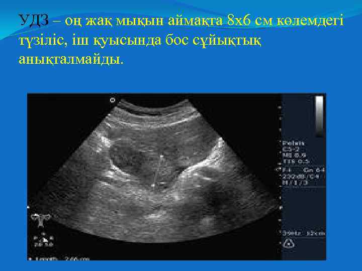 УДЗ – оң жақ мықын аймақта 8 х6 см көлемдегі түзіліс, іш қуысында бос