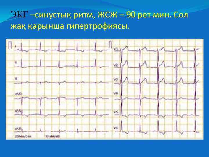 ЭКГ –синустық ритм, ЖСЖ – 90 рет мин. Сол жақ қарынша гипертрофиясы. 