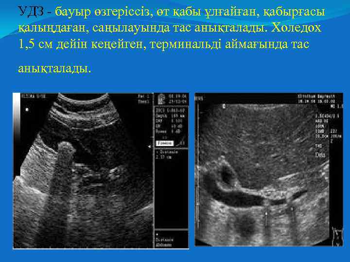 УДЗ - бауыр өзгеріссіз, өт қабы ұлғайған, қабырғасы қалыңдаған, саңылауында тас анықталады. Холедох 1,