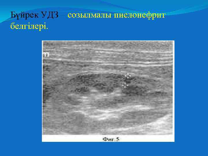 Бүйрек УДЗ – созылмалы пиелонефрит белгілері. 
