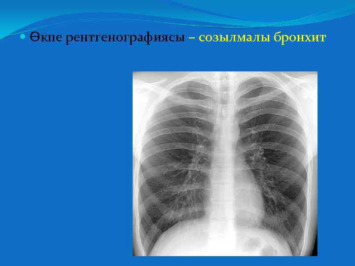  Өкпе рентгенографиясы – созылмалы бронхит 