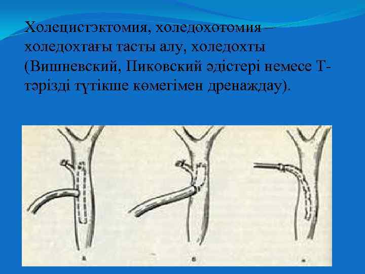 Холецистэктомия, холедохотомия – холедохтағы тасты алу, холедохты (Вишневский, Пиковский әдістері немесе Ттәрізді түтікше көмегімен
