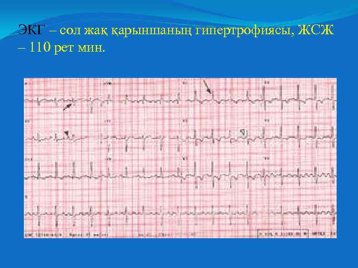 ЭКГ – сол жақ қарыншаның гипертрофиясы, ЖСЖ – 110 рет мин. 