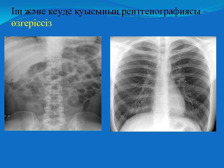 Іш және кеуде қуысының рентгенографиясы – өзгеріссіз 