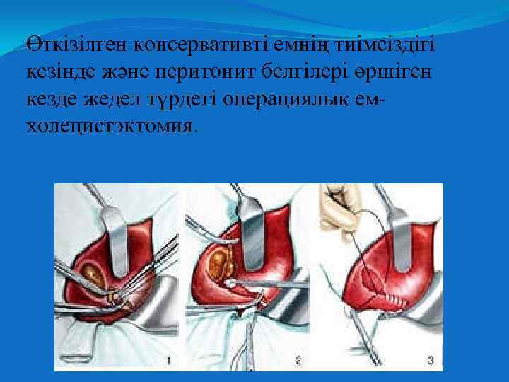 Өткізілген консервативті емнің тиімсіздігі кезінде және перитонит белгілері өршіген кезде жедел түрдегі операциялық емхолецистэктомия.