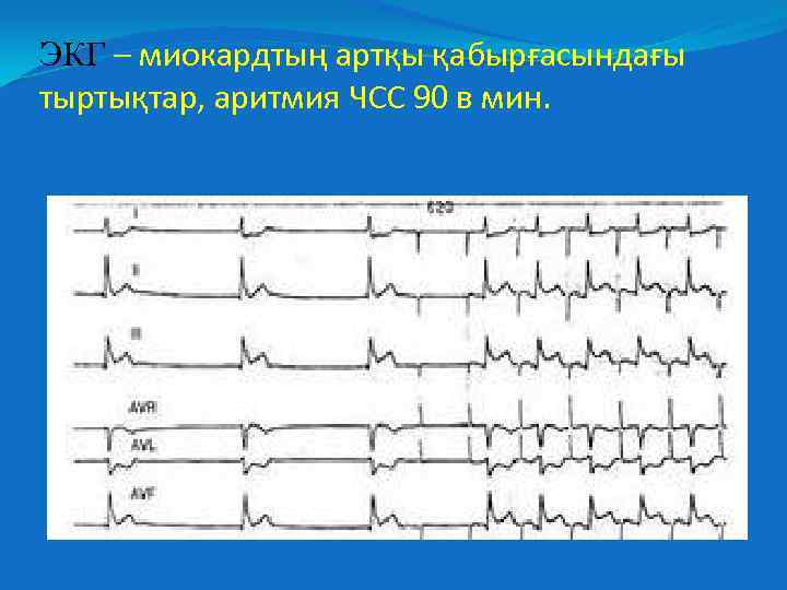 ЭКГ – миокардтың артқы қабырғасындағы тыртықтар, аритмия ЧСС 90 в мин. 