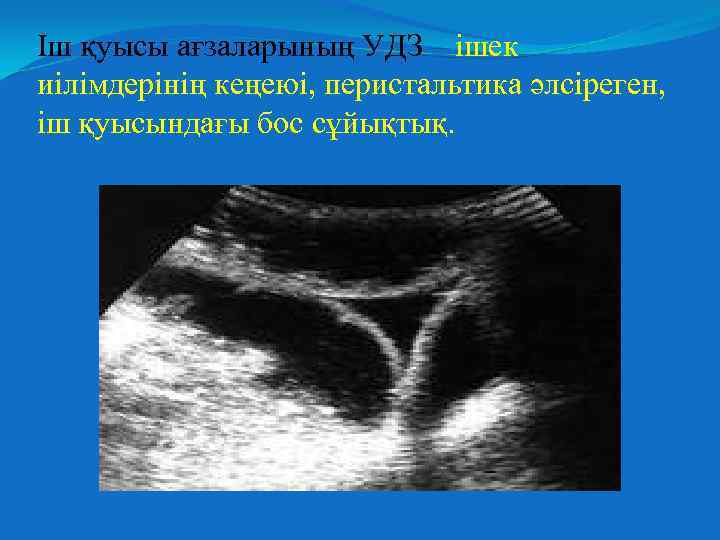 Іш қуысы ағзаларының УДЗ – ішек иілімдерінің кеңеюі, перистальтика әлсіреген, іш қуысындағы бос сұйықтық.