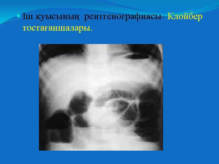  Іш қуысының рентгенографиясы- Клойбер тостағаншалары. 
