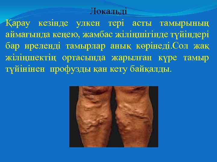 Локальді Қарау кезінде улкен тері асты тамырының аймағында кеңею, жамбас жіліңшігінде түйіндері бар иреленді