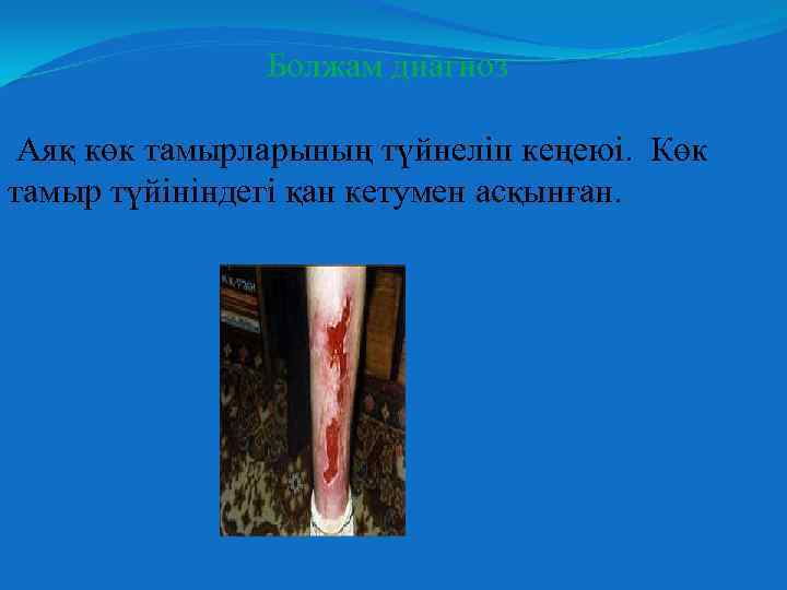 Болжам диагноз Аяқ көк тамырларының түйнеліп кеңеюі. Көк тамыр түйініндегі қан кетумен асқынған. 