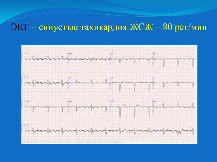 ЭКГ – синустық тахикардия ЖСЖ – 80 рет/мин 