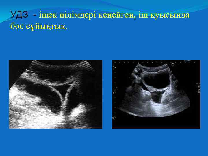 УДЗ - ішек иілімдері кеңейген, іш қуысында бос сұйықтық. 