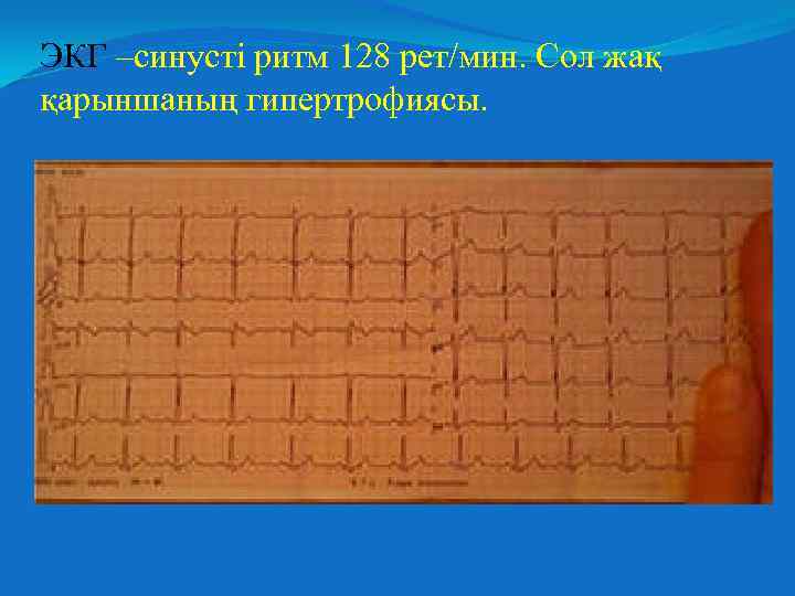 ЭКГ –синусті ритм 128 рет/мин. Сол жақ қарыншаның гипертрофиясы. 