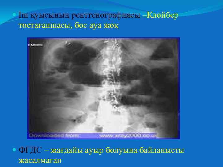  Іш қуысының рентгенографиясы –Клойбер тостағаншасы, бос ауа жоқ ФГДС – жағдайы ауыр болуына