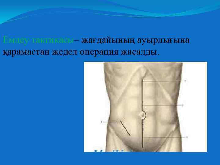 Емдеу тактикасы– жағдайының ауырлығына қарамастан жедел операция жасалды. 