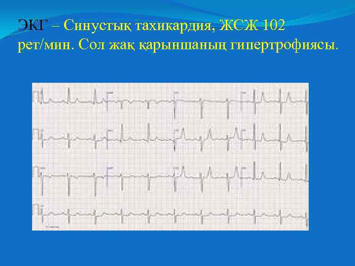 ЭКГ – Синустық тахикардия, ЖСЖ 102 рет/мин. Сол жақ қарыншаның гипертрофиясы. 