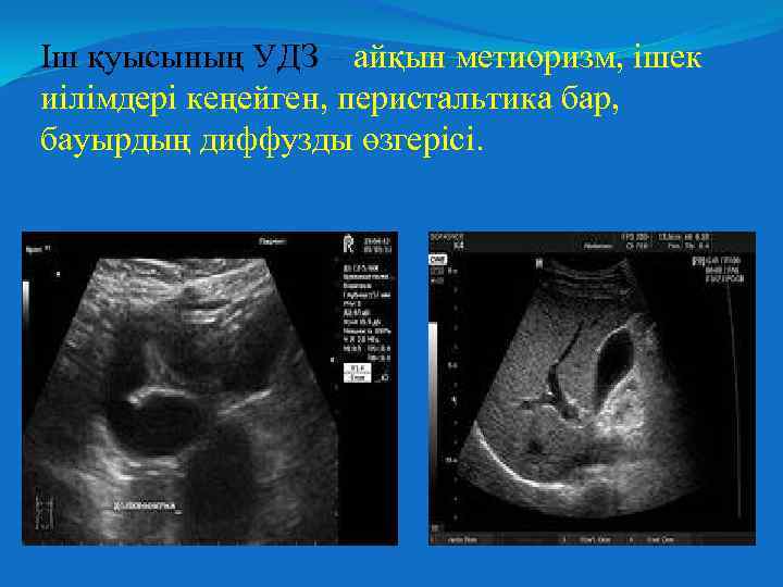Іш қуысының УДЗ – айқын метиоризм, ішек иілімдері кеңейген, перистальтика бар, бауырдың диффузды өзгерісі.