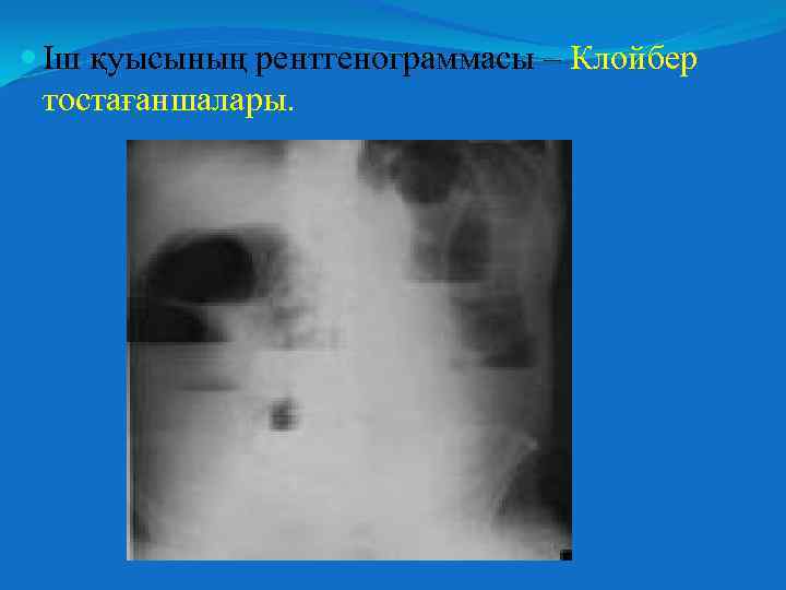  Іш қуысының рентгенограммасы – Клойбер тостағаншалары. 