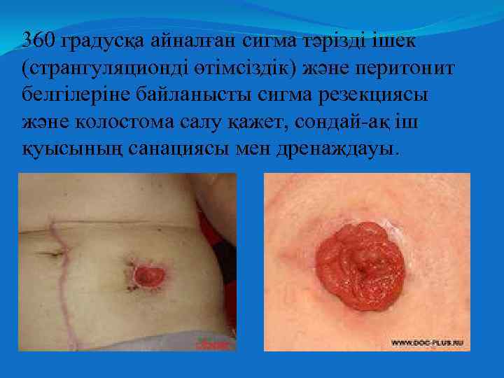 360 градусқа айналған сигма тәрізді ішек (странгуляционді өтімсіздік) және перитонит белгілеріне байланысты сигма резекциясы