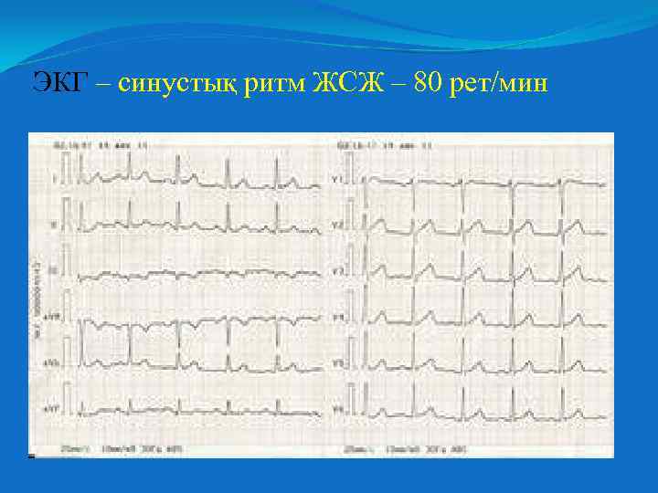 ЭКГ – синустық ритм ЖСЖ – 80 рет/мин 